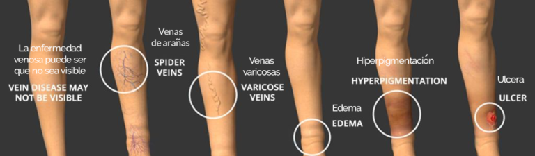 Enfermedad Venosa — Medical Vein Clinic